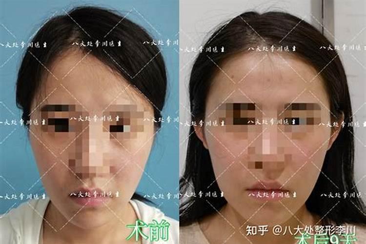 贴面耳和招风耳哪个好贴面耳大富大贵之相
