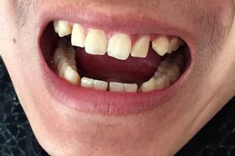 梦见掉牙三个破解方法