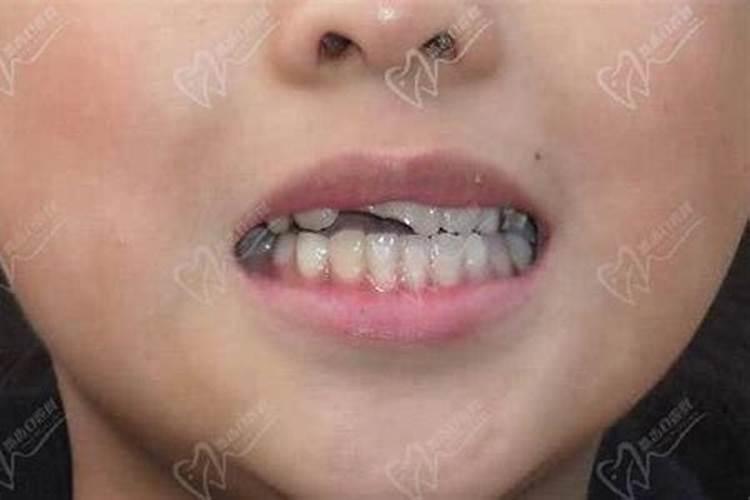 女人梦见上牙掉了是吉兆吗