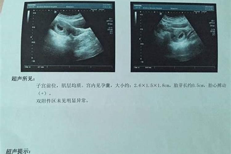 孕囊怎么处理才算超度做完人流后怎么恢复？