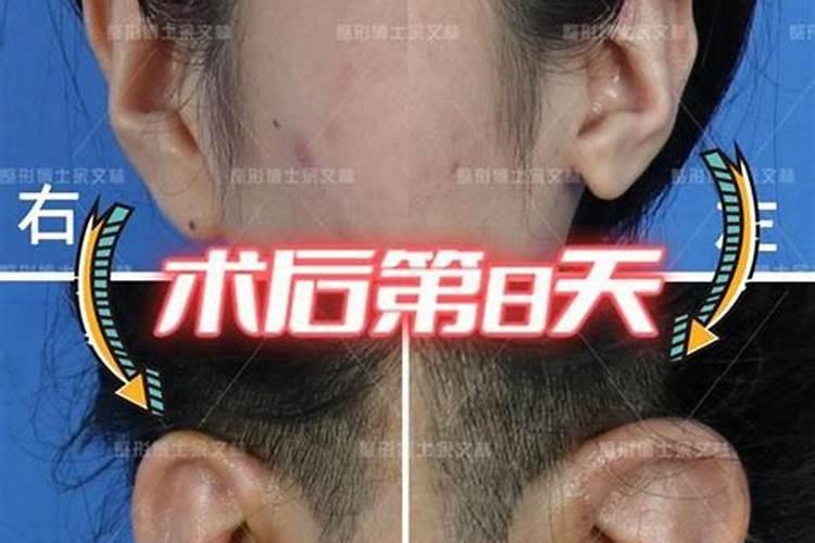如果一段时间发现你的脸型慢慢变圆,耳垂慢慢增大增厚,而且有显出发福痕。